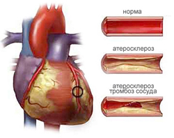 Атеросклероз вінцевих артерій серця