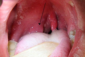 Білі точки на мигдалинах в горлі - плями на гландах у дорослого