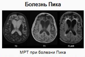 Хвороба піку - причини, симптоми, діагностика та лікування хвороби піку, клініки ізраїлю, лікування в