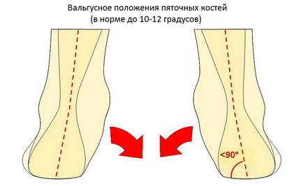 Хвороба Хаглунд, фото до і після, операція, відгуки, лікування, реабілітація та відновлення