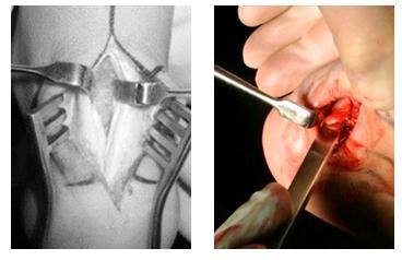 Хвороба Хаглунд, фото до і після, операція, відгуки, лікування, реабілітація та відновлення
