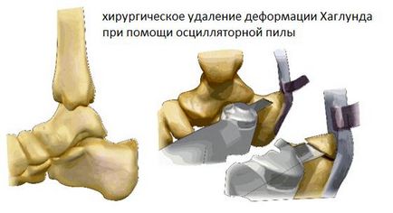 Хвороба Хаглунд, фото до і після, операція, відгуки, лікування, реабілітація та відновлення