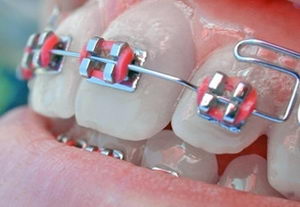 Paranteze Daimon - o revoluție în ortodonție - despre corecția mușcăturii și acolade