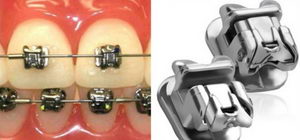 Paranteze Daimon - o revoluție în ortodonție - despre corecția mușcăturii și acolade
