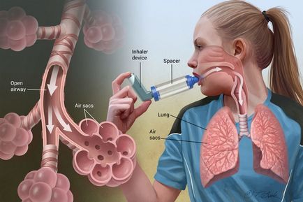 Astm bronșic de prim ajutor în caz de atac - cauze, simptome, tratament, prevenire, știri
