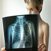 Bronchitis - Kezelés és tünetei gyermekkorban gyorsan gyógyítja a betegséget