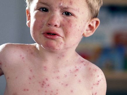Mennyire veszélyes Coxsackie vírus - egészséges információk (veszélyes) Mennyire veszélyes Coxsackie vírus - Egészséges információ