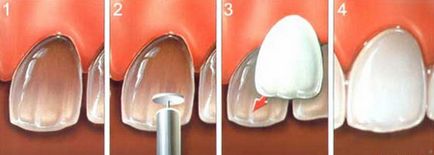 Що таке люмініри як встановлюються люмініри на зуби відгуки, вартість, фото до і після