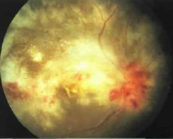 Цитомегаловірусний (ЦМВ) ретиніт і різновиди увеїт при СНІДі