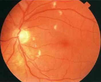 Cytomegalovirus (CMV) retinita si varietati de uveita cu SIDA