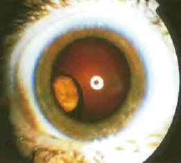 Цитомегаловірусний (ЦМВ) ретиніт і різновиди увеїт при СНІДі