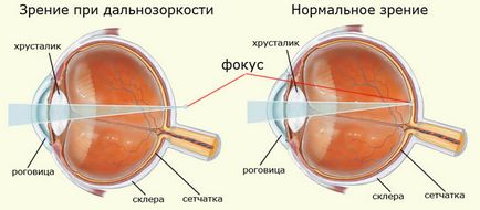 Hyperopia la copii