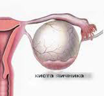 Chistul ovarian dermoid - cauze, simptome, diagnostic și tratament