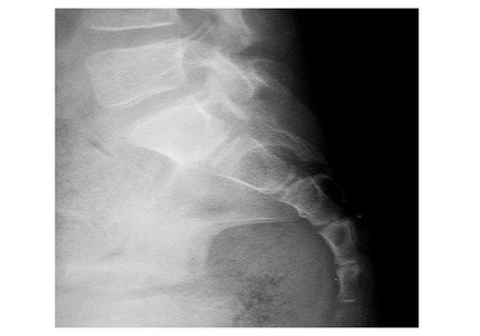 Diagnosticul și tratamentul unui sacrum fracturat