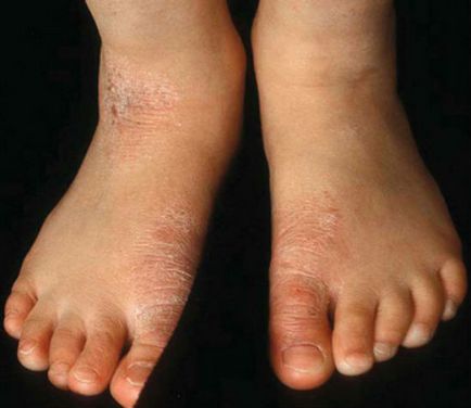 Eczema dishidrotică la copii - principalele metode de tratament