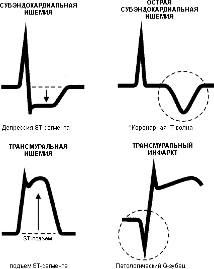 ЕКГ з поясненнями