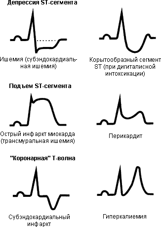 ЕКГ з поясненнями