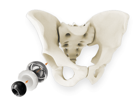 Endoproteticele clinicii Sim joint în Spania