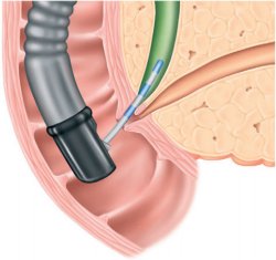 Cholangiopancreatografia endoscopică retrogradă (erhpg)