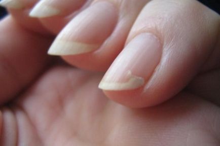 În cazul în care unghiile sunt tăiate top 5 sfaturi utile, unghii frumoase - adăugarea de imagine