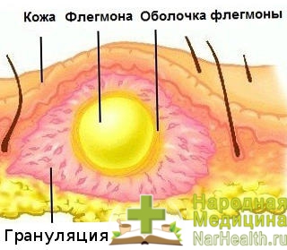 Флегмона шиї, дна порожнини рота - симптоми, лікування флегмони, фото
