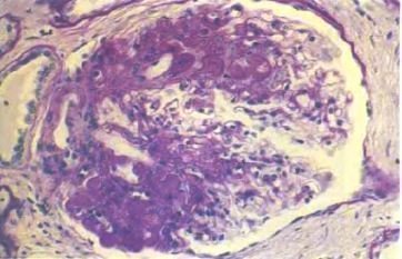 Focal-segmentar glomeruloscleroza