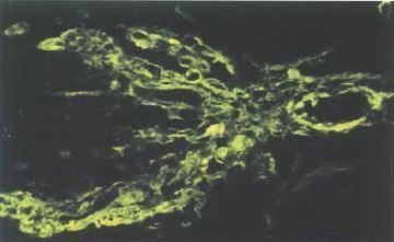 Focal-segmentar glomeruloscleroza