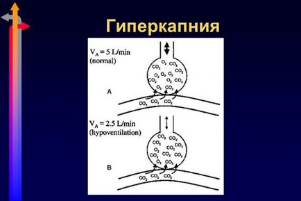 Гіперкапнія і гіпоксемія - симптоми і лікування