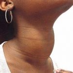 Hipotiroidism - cauze, simptome, tratament cu metode populare