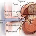 Hipotiroidism - cauze, simptome, tratament cu metode populare