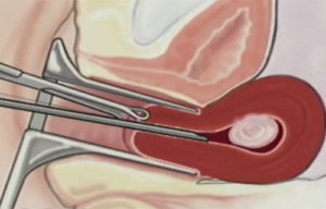 Гістероскопічна міомектомія особливості проведення процедури