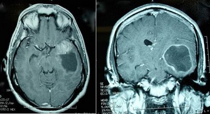 Гліобластома головного мозку лікування, діагностика, симптоми - фото