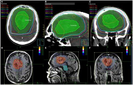 Glioblastomul tratamentului cerebral, diagnosticul, simptomele - fotografie