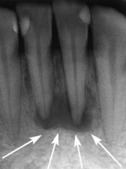 Granulomul dentar - simptome și tratament - ceea ce este perodontită granulomatoasă - dentară