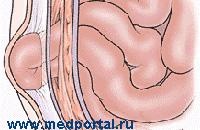 Herniated abdomen