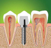 Implantul de dinți în medicina dentară 