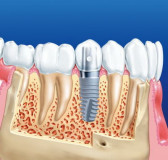 Імплантація зубів в Адлері - стоматологія «медикус»