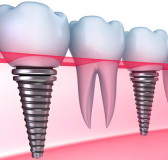 Implantul de dinți în medicina dentară 