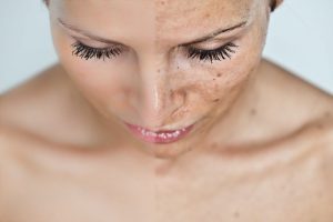 Як відбілити пігментні плями на обличчі в домашніх умовах