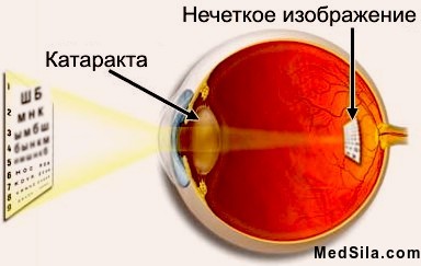 Simptome de cataractă, diagnostic și tratament