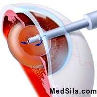 Simptome de cataractă, diagnostic și tratament
