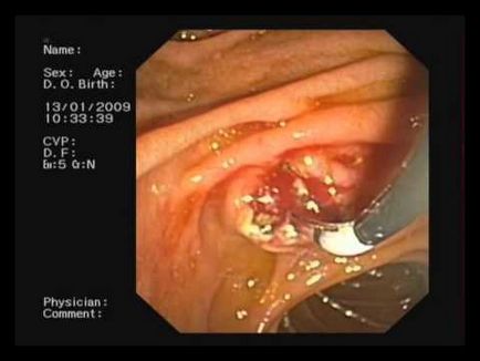 Cyst vaszkuláris plexus a magzatban és újszülött (vaszkuláris) Cyst vaszkuláris plexus a magzatban és újszülött