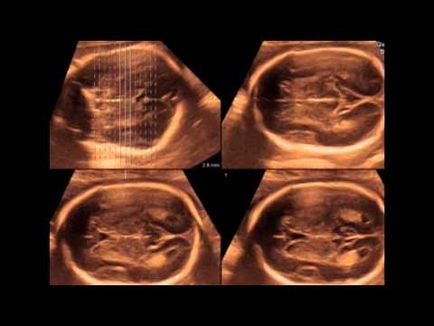 Cyst vaszkuláris plexus a magzatban és újszülött (ciszták) Cyst vaszkuláris plexus a magzatban és újszülött