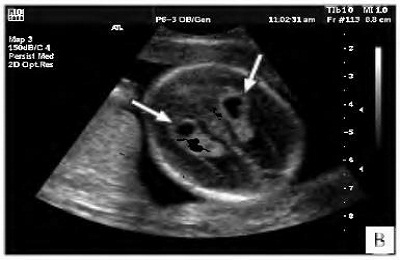 Cyst vaszkuláris plexus a magzatban és újszülött (vaszkuláris) Cyst vaszkuláris plexus a magzatban és újszülött