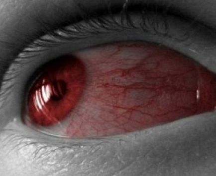 Proteine ​​de ochi roșii - ce să faci