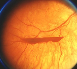 Hemoragia în retină a ochiului - ce să facă un buletin medical