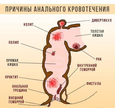 Кровоточить геморой лікування в домашніх умовах, лікування кровоточить геморою будинку