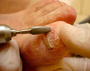 Лікування грибка нігтів - центр краси - класик - ростов-на-дону