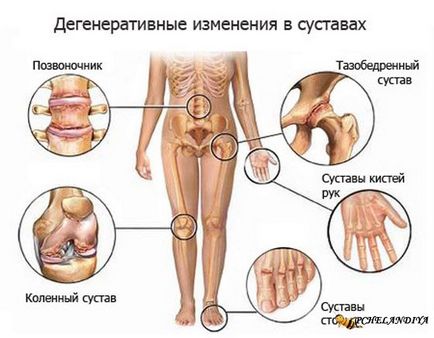 Tratamentul medicamentelor folclorice pentru artrita reumatoidă