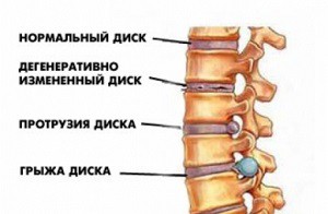 Лікування спини в домашніх умовах при остеохондрозі - вправи, масаж, харчування